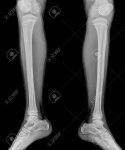 39098986-detail-of-an-x-ray-of-child-leg.jpg